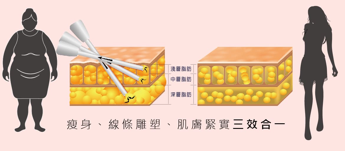 瘦身、線條雕塑、肌膚緊實三效合一抽脂雕塑