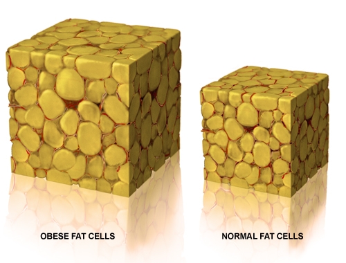運動減肥減的是脂肪細胞體積，脂肪細胞數量只能靠抽脂手術